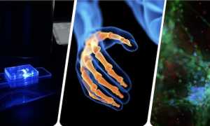 upo flamingo artrite